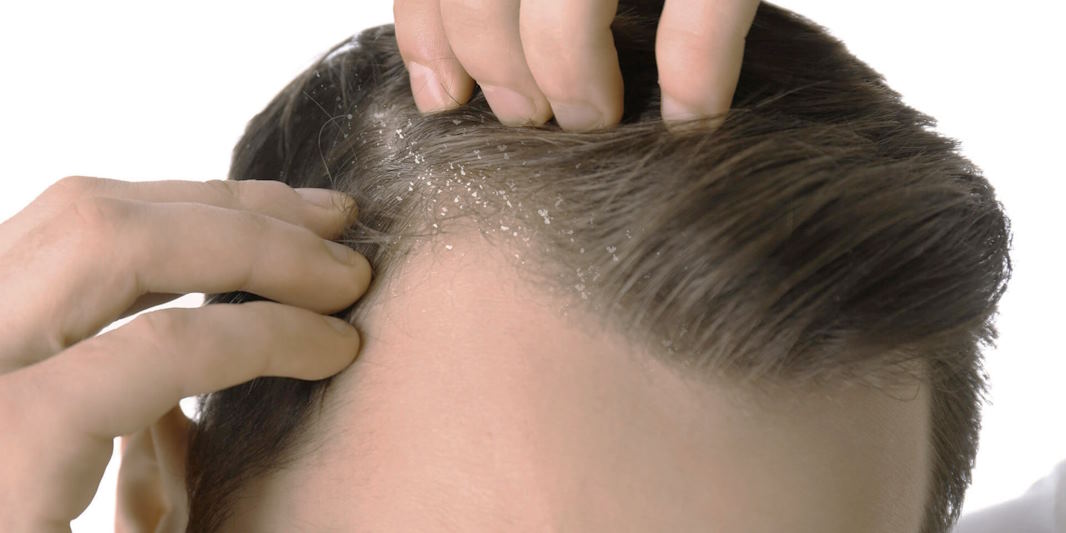 causes of dandruff